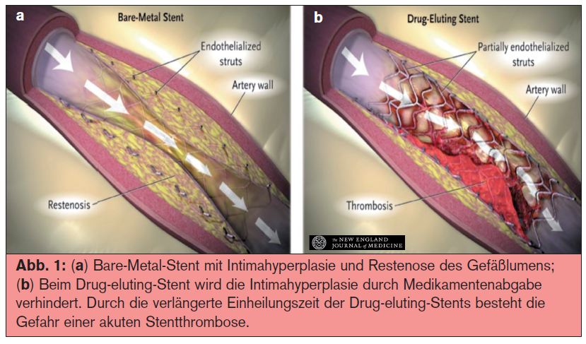 Absetzen von Clopidogrel und BridgingOptionen