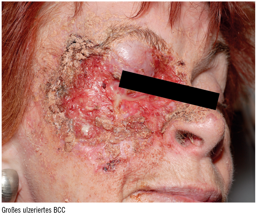 PharmaWiki - Aktinische Keratose PharmaWiki - Aktinische Keratose