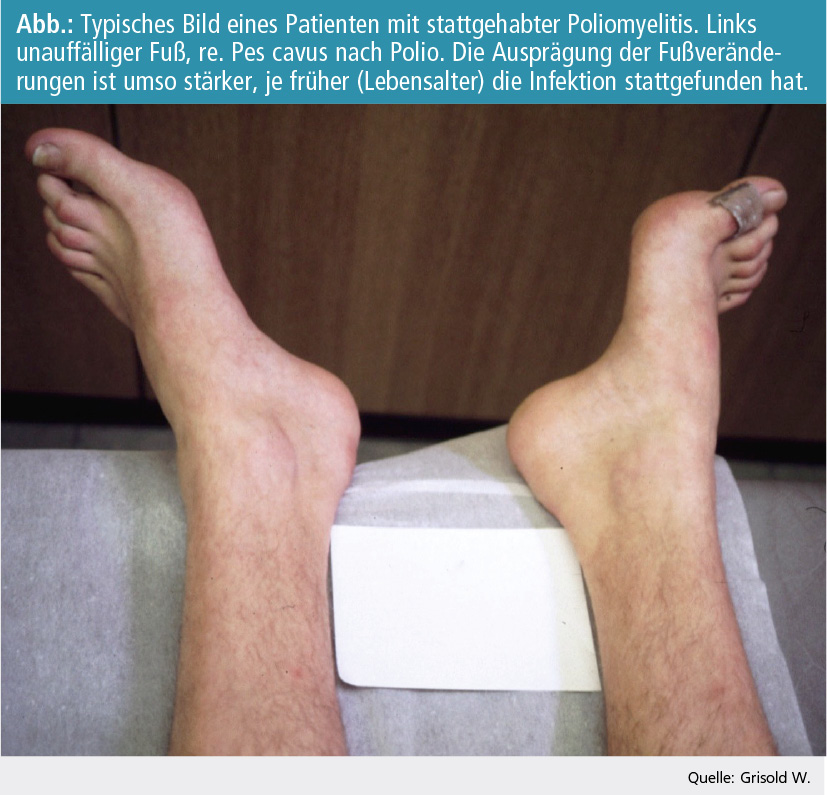 Rehabilitation nach Poliomyelitis Neurologisch MedMedia