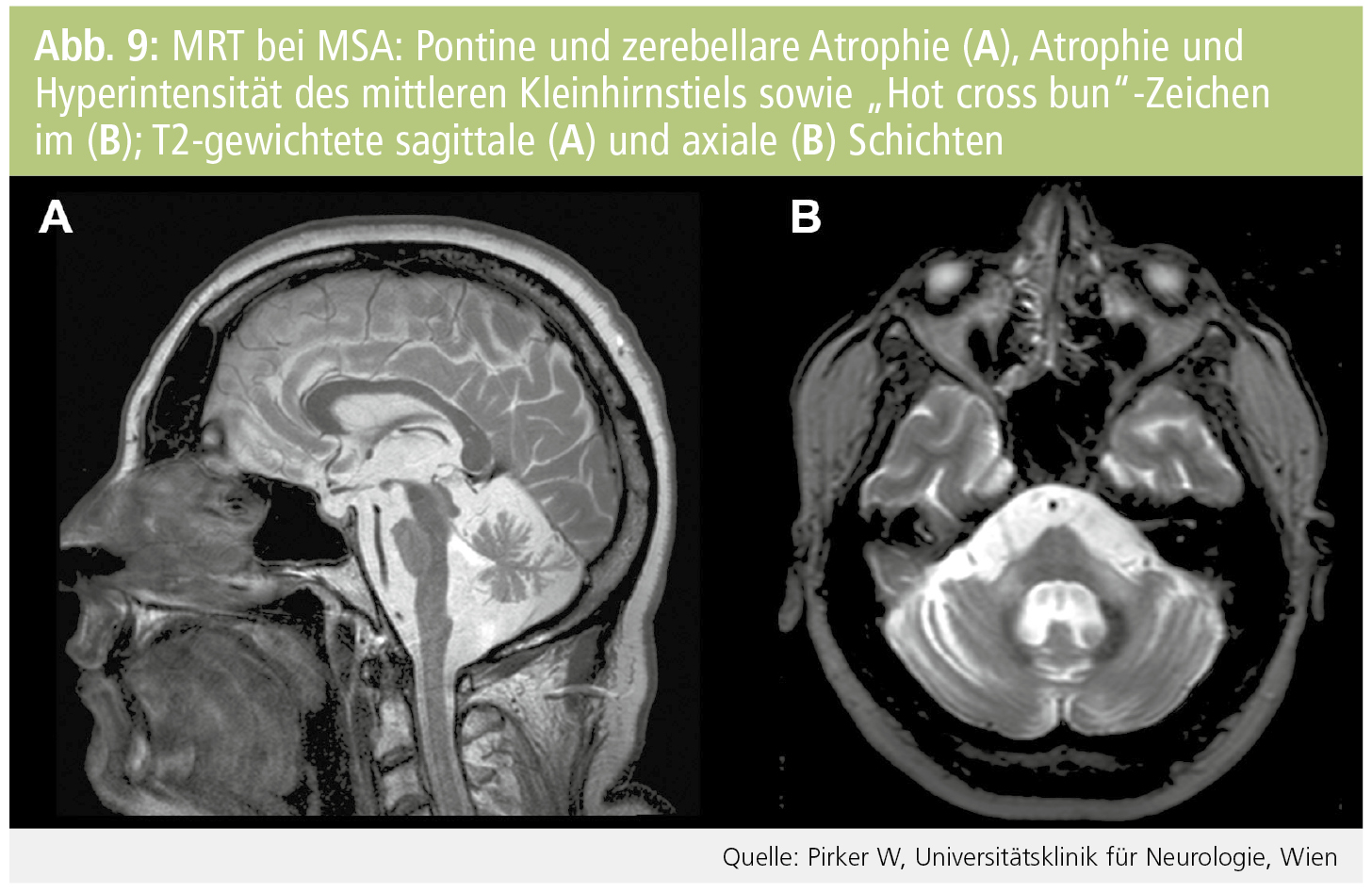 Neuroimaging Bei Parkinson Syndromen Medmedia