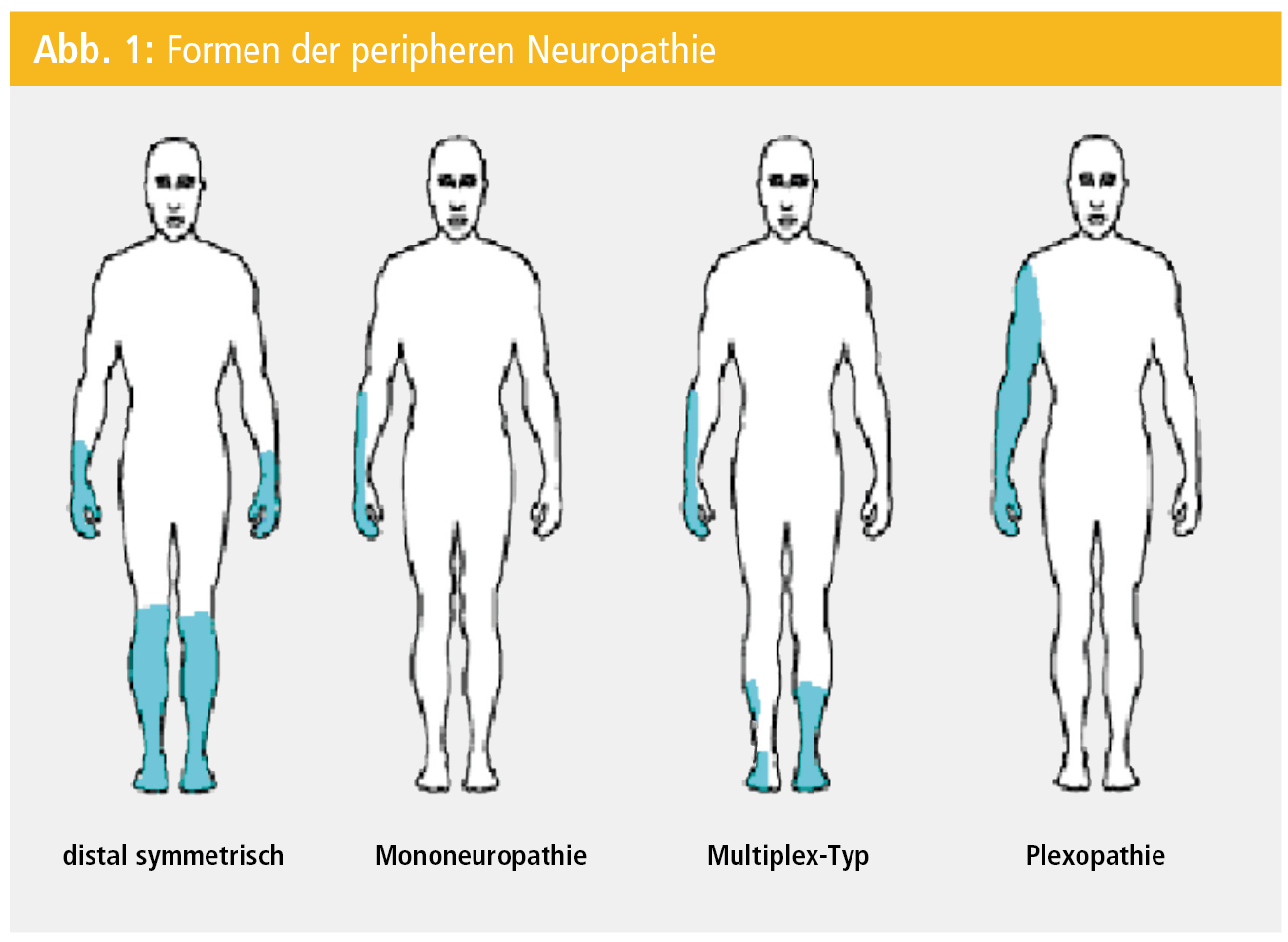 Diabetes mellitus mit Polyneuropathie: Ein komplexes Krankheitsbild