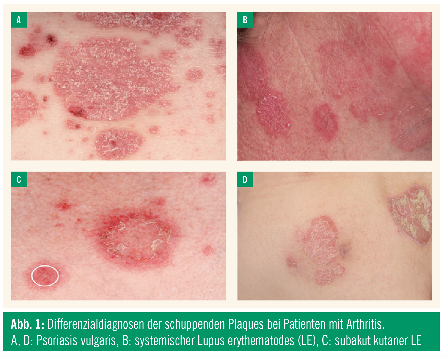 Psoriasis