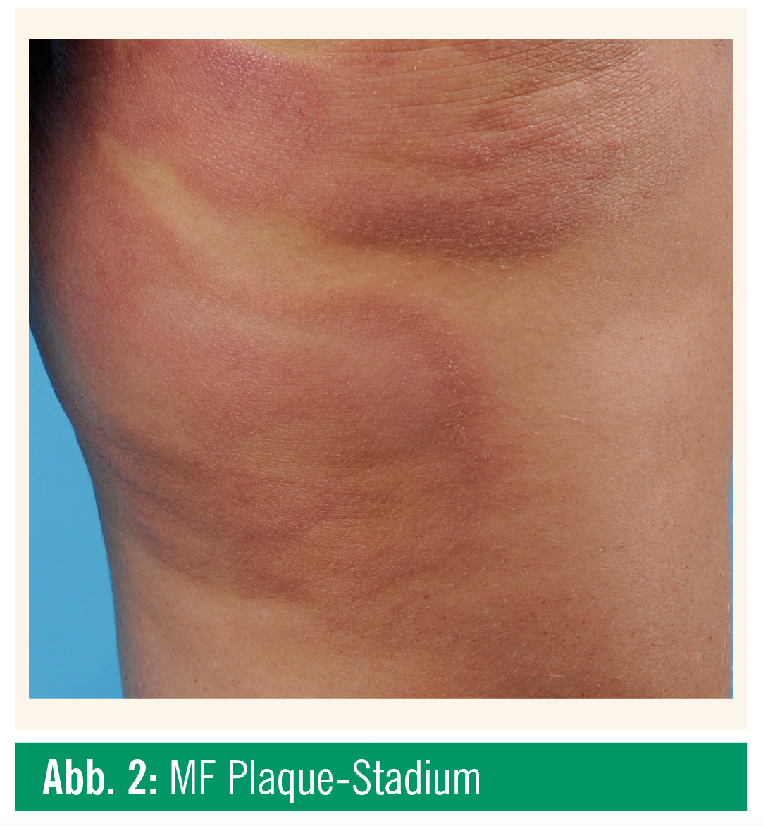 Primär kutane TZellLymphome Spectrum Dermatologie MedMedia
