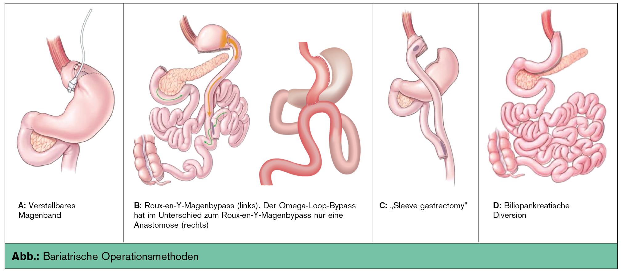 Forum magenbypass Forum