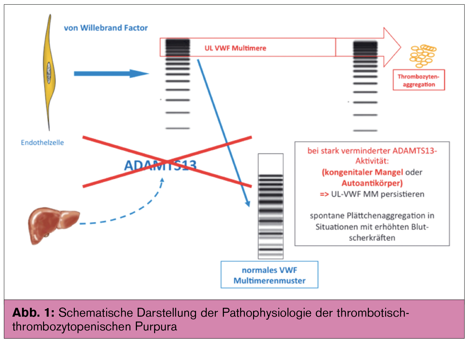 Pathophysiologie Diagnostik Und Moderne Therapiemoglichkeiten Die Thrombotisch Thrombozytopenische Purpura Ttp Medmedia