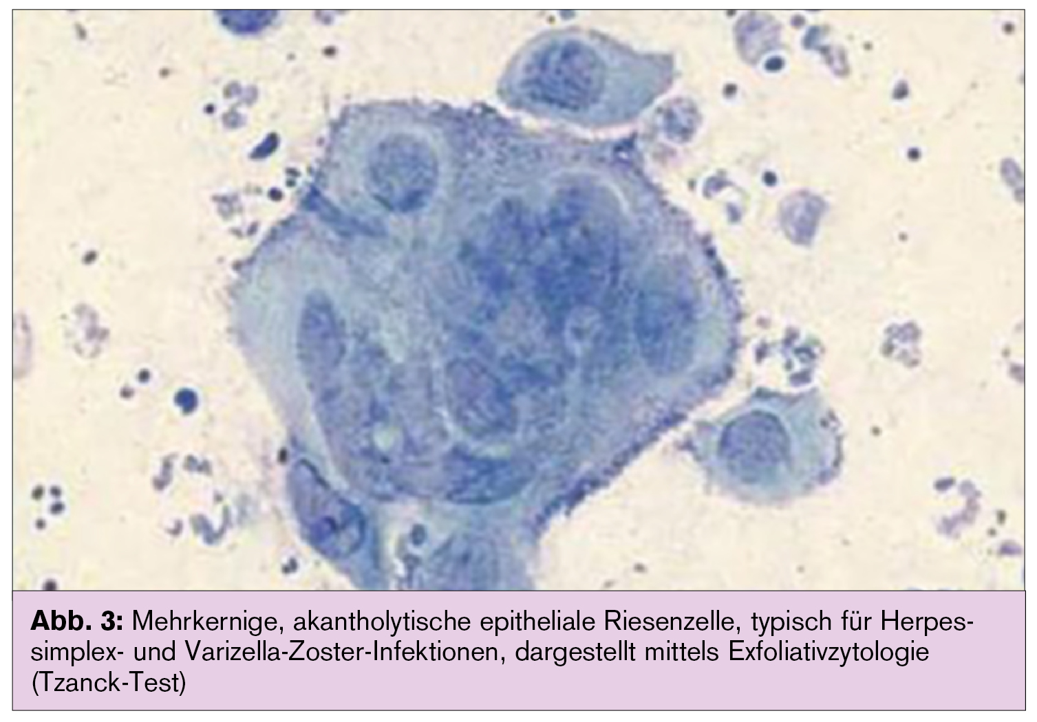 Herpes Genitalis Medmedia