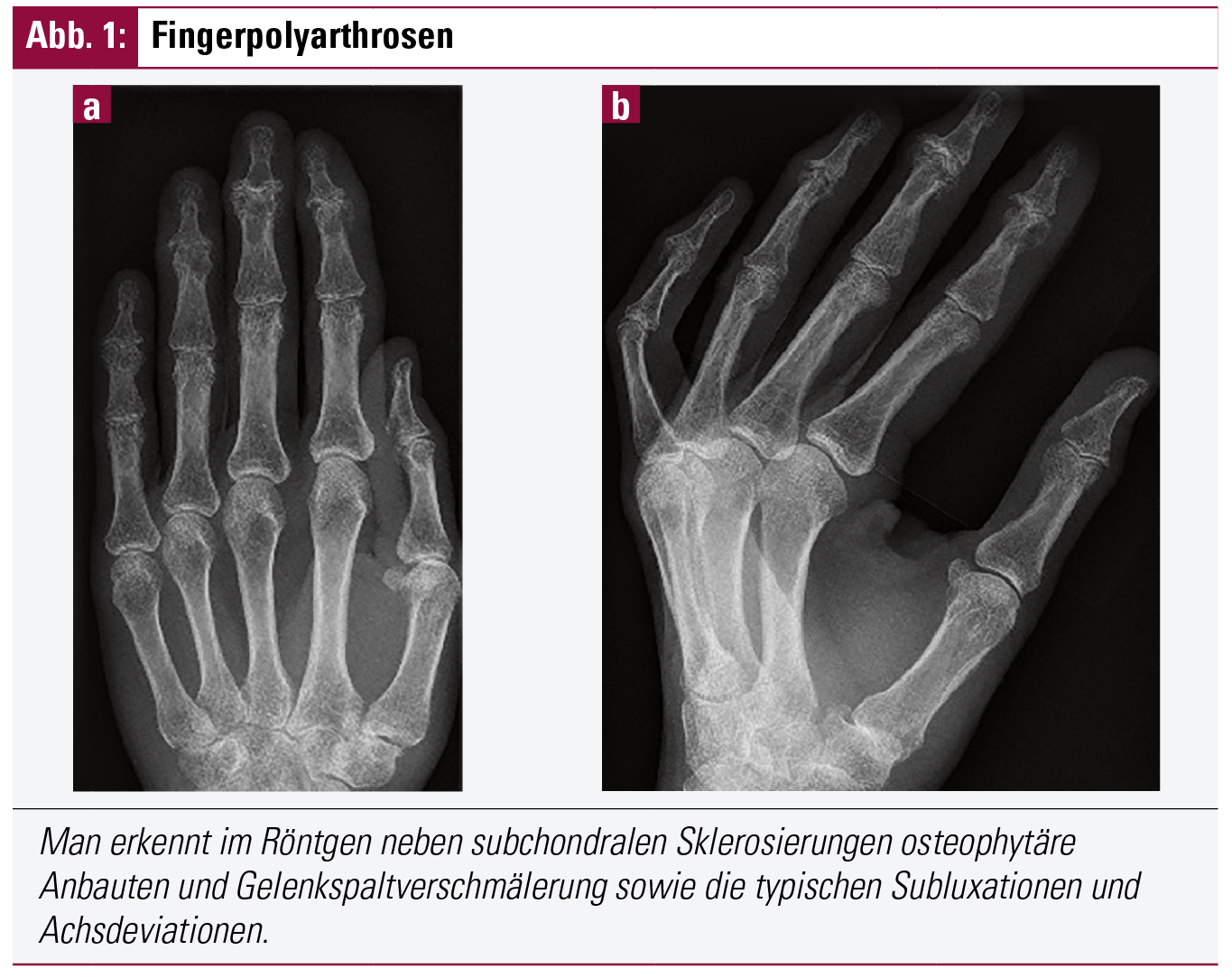 Fingerpolyarthrosen: Welche chirurgischen Verfahren sind sinnvoll? | Fakten der Rheumatologie ...
