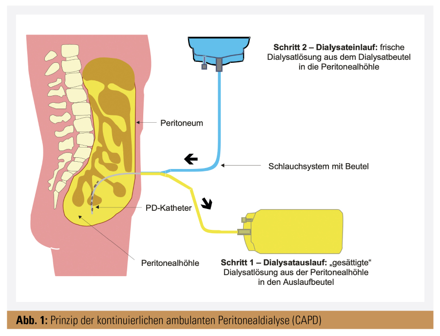 Peritonealdialyse für Internisten | univ-innere-medizin